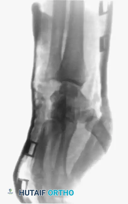 Fig. 64-31 Dislocation of fourth and ﬁ fth carpometacarpal joints. A, Clinical appearance of hand before reduction. Note dorsoulnar hand swelling consistent with injury. B, Posteroanterior view. C, Lateral view. D, Oblique view. E and F, Traction was adequate to reduce, and splint was satisfactory to maintain reductions.