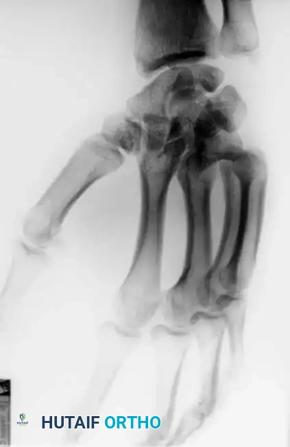 Fig. 64-31 Dislocation of fourth and ﬁ fth carpometacarpal joints. A, Clinical appearance of hand before reduction. Note dorsoulnar hand swelling consistent with injury. B, Posteroanterior view. C, Lateral view. D, Oblique view. E and F, Traction was adequate to reduce, and splint was satisfactory to maintain reductions.