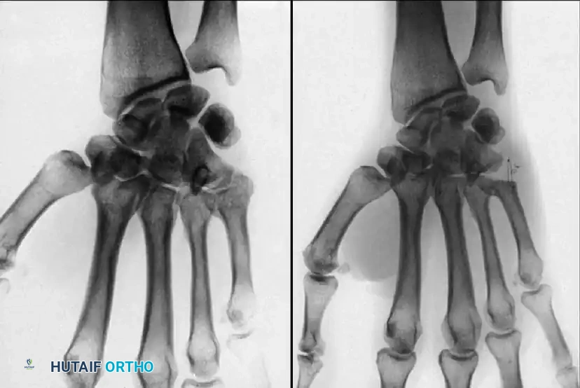 FOUR MEDIAL METACARPALS Surgical Diagram