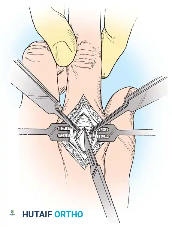 Fig. 64-36 Dorsal surgical approach to dislocated metacarpophalangeal joint. Volar plate caught over dorsal area of metacarpal head is incised longitudinally, and reduction is easily achieved.