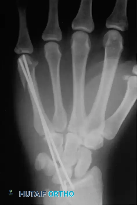 Fig. 64-37 Radiograph showing reduction and ﬁ xation of fracture of metacarpal shaft and neck.