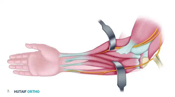 Fractional Lengthening of the Flexor Carpi Radialis and Finger Flexors