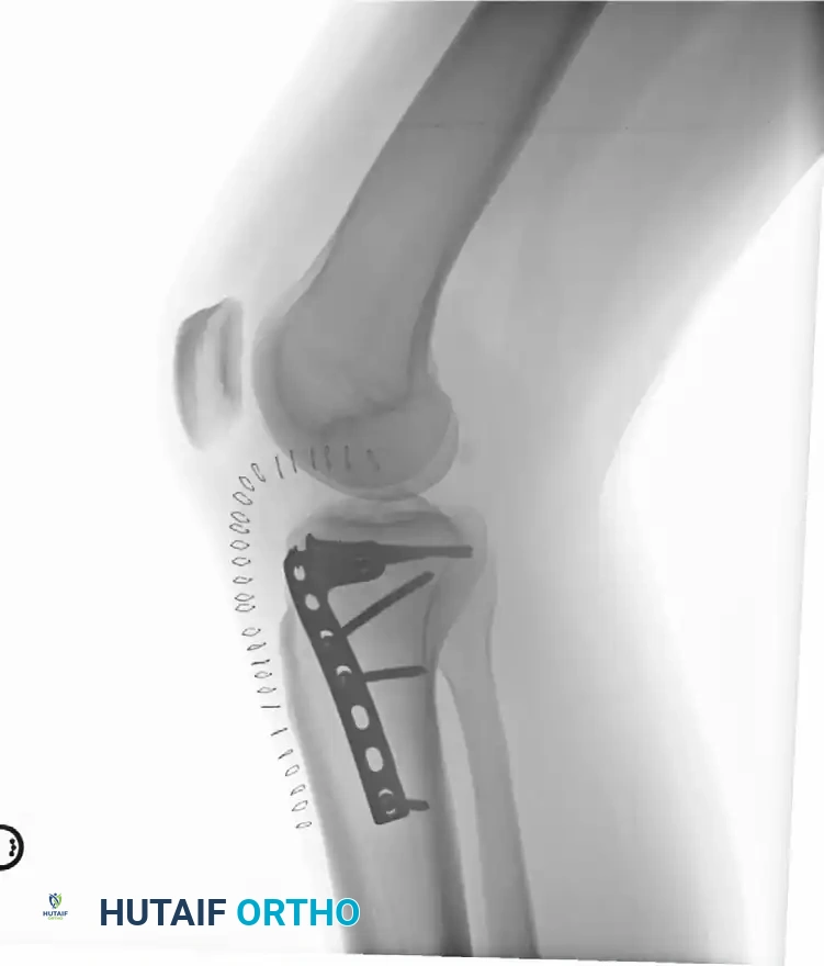 Type II Fracture-Dislocation X-Ray B