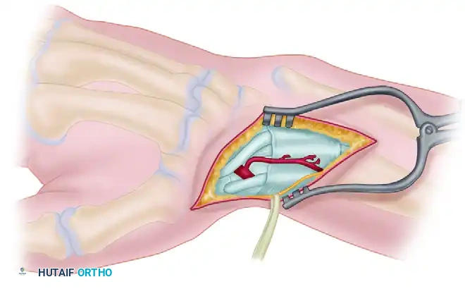 FRACTURE OF THE HAMATE Surgical Diagram