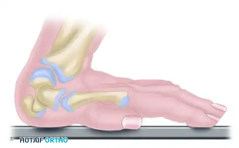 FRACTURE OF THE HAMATE Surgical Diagram