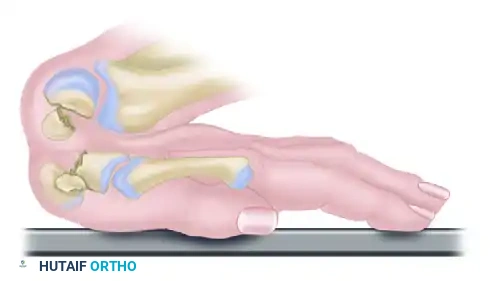FRACTURE OF THE HAMATE Surgical Diagram