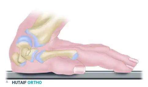 FRACTURE OF THE HAMATE Surgical Diagram
