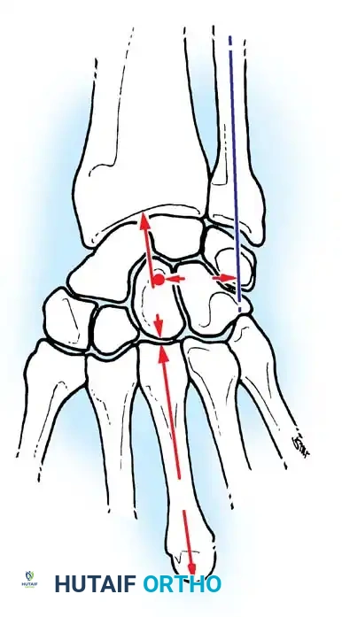 صورة مرجعية لحالات الانهيار المتقدم للرسغ