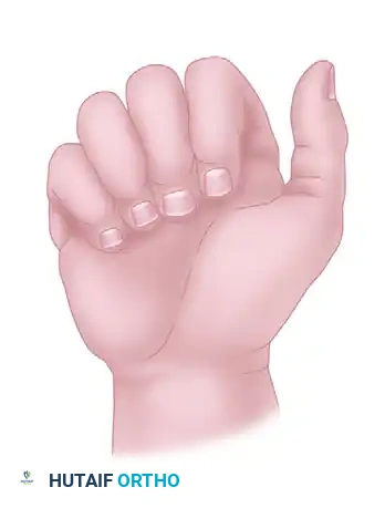 Hand Fractures, Dislocations, and Ligamentous Injuries: Principles of Operative Treatment