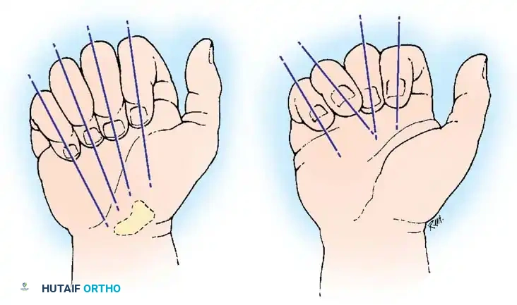 Principles of Hand Fracture and Dislocation Management