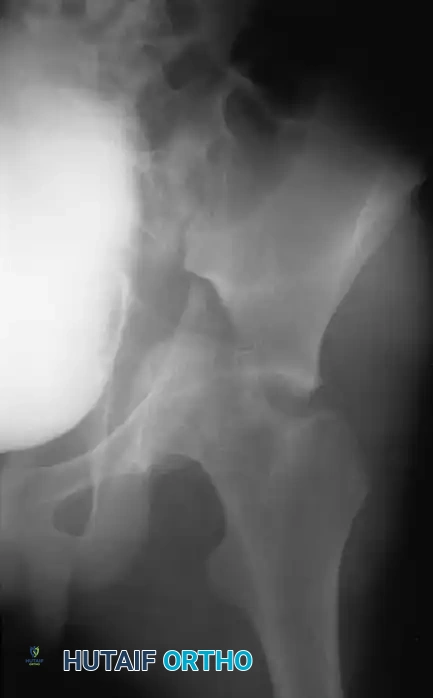FIGURE 56-4 Anteroposterior pelvic radiograph (A) and CT scan (B) of irreducible hip dislocation with posterior wall acetabular fracture. Posterior wall fragment is incarcerated, blocking reduction.