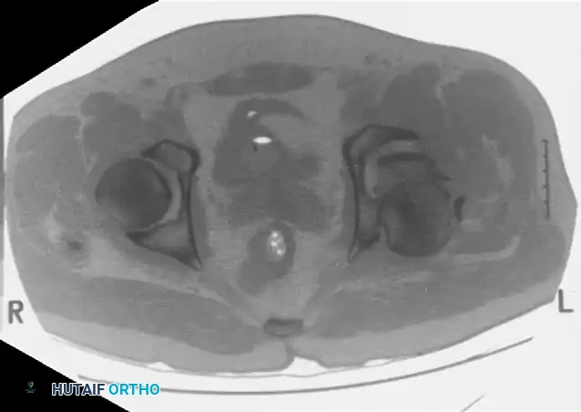 FRACTURES OF ACETABULUM AND PELVIS James L. Guyton • Edward A. Perez Surgical Diagram