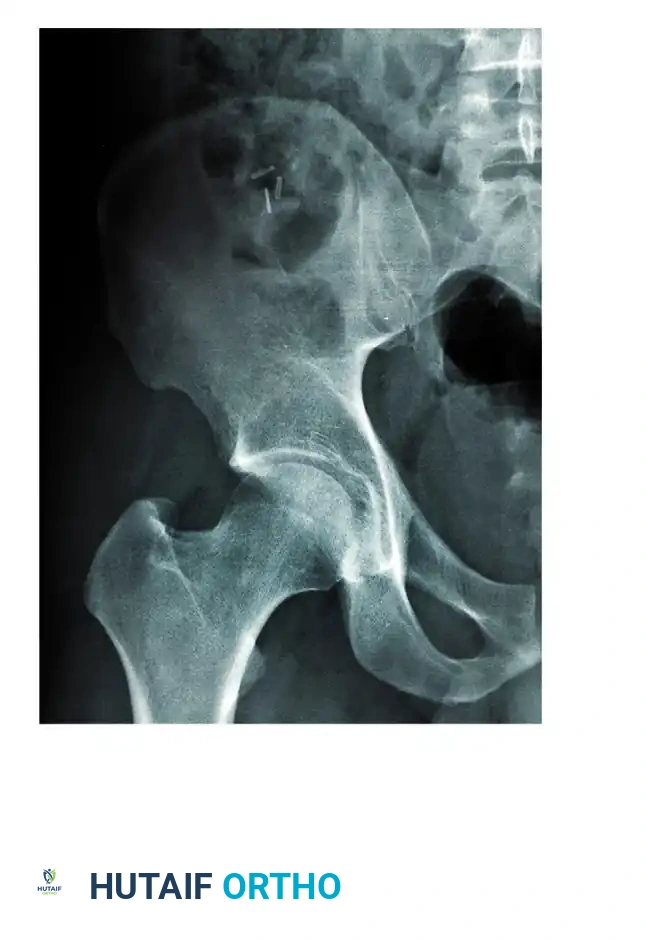 FRACTURES OF ACETABULUM AND PELVIS James L. Guyton • Edward A. Perez Surgical Diagram