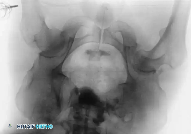Fig. 53-4 Anteroposterior pelvic radiograph ( A ) and CT scan ( B ) of irreducible hip dislocation with posterior wall acetabular fracture. Posterior wall fragment is incarcerated, blocking reduction.