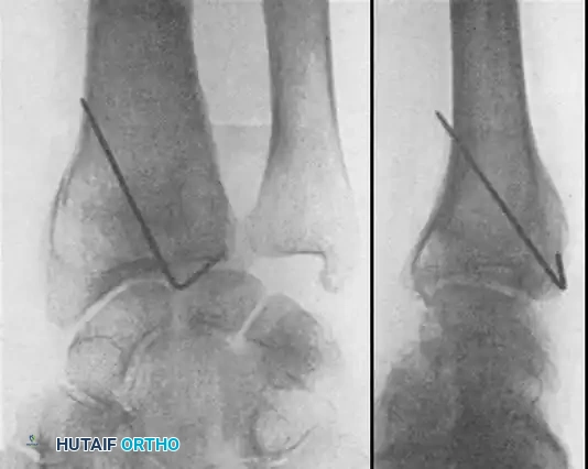 Fig. 54-103 A and B, Four-part type III distal radial fracture treated by open reduction, internal ﬁ xation of intraarticular component, iliac bone grafting, and external ﬁ xation. C and D, Follow-up radiographs at 5 weeks (C) and 3 years (D) show anatomical restoration of joint surface, maintenance of radial length, and absence of degenerative changes. (From Fernandez DL: Fractures of the distal radius: operative treatment, Instr Course Lect 42:73, 1993.)