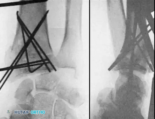 FRACTURES OF THE DISTAL RADIUS Surgical Diagram