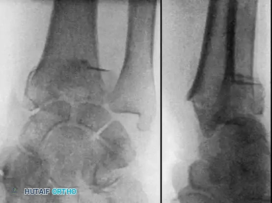 FRACTURES OF THE DISTAL RADIUS Surgical Diagram