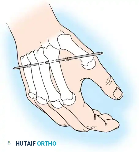 FRACTURES OF THE DISTAL RADIUS Surgical Diagram