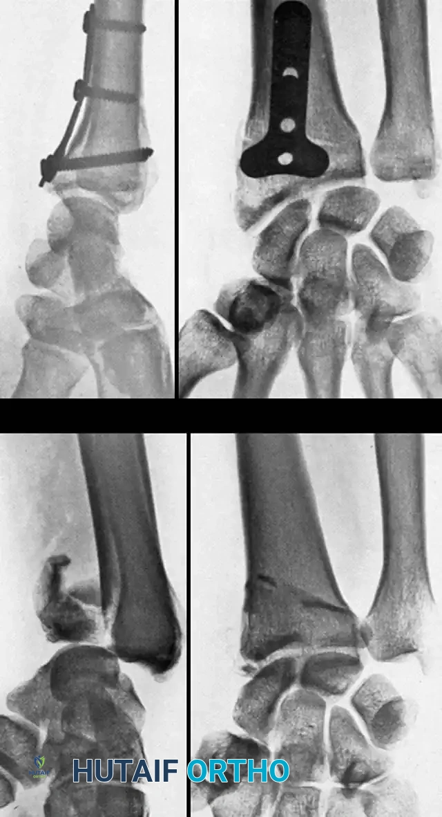 FRACTURES OF THE DISTAL RADIUS Surgical Diagram