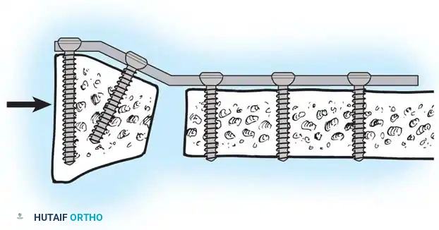 FRACTURES OF THE DISTAL RADIUS Surgical Diagram