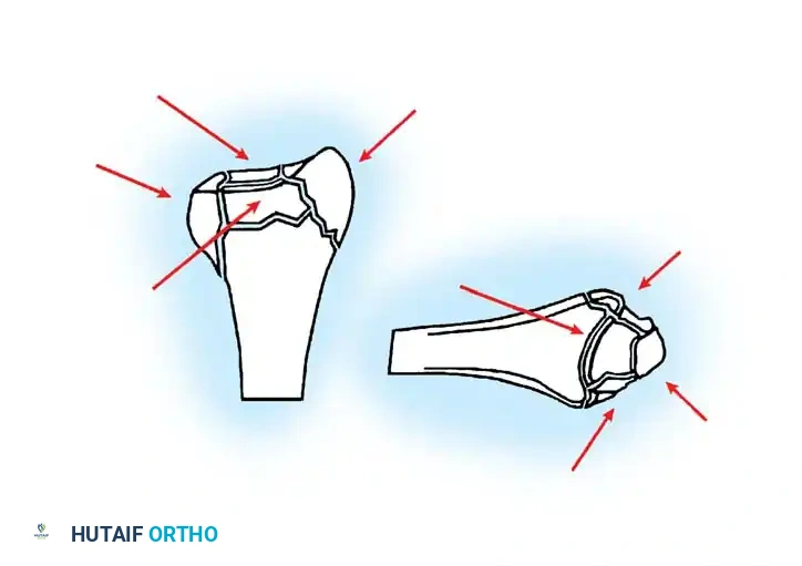 FRACTURES OF THE DISTAL RADIUS Surgical Diagram