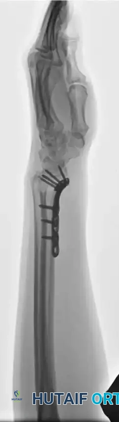 FRACTURES OF THE DISTAL RADIUS Surgical Diagram