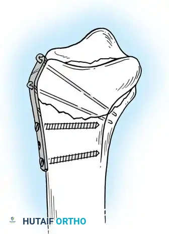 FRACTURES OF THE DISTAL RADIUS Surgical Diagram