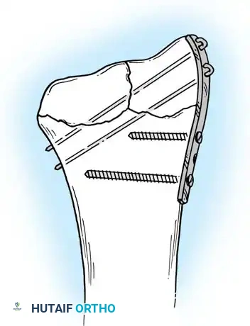 FRACTURES OF THE DISTAL RADIUS Surgical Diagram