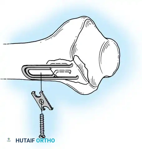 FRACTURES OF THE DISTAL RADIUS Surgical Diagram