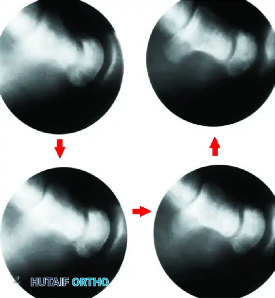 Lunate healed (12 mo)