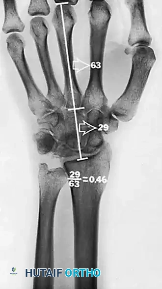 FRACTURES OF THE LUNATE AND KIENBÖCK DISEASE Surgical Diagram