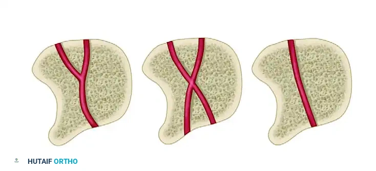 FIGURE 69-52 A, Common fracture pattern in Kienböck disease is so-called anterior pole type, isolating anterior pole of lunate from remaining portion of bone. Distraction of fracture caused by compressive force exerted by capitate diminishes likelihood of fracture healing. This detail usually is invisible on routine radio­ graphs because radial styloid process is superimposed on fracture gap. As dorsal portion of lunate collapses further, anterior pole may be extruded volarly. B, Ratio of height of carpus to length of third metacarpal is reduced in this patient with Kienböck disease. This ratio in normal wrists has been reported to be 0.54 ± 0.03, and significantly reduced ratios indicate overall carpal collapse.