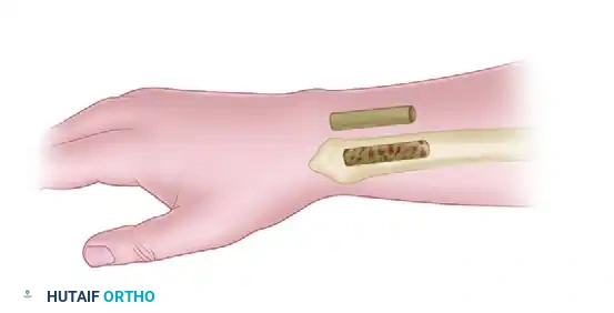 FRACTURES OF THE LUNATE AND KIENBÖCK DISEASE Surgical Diagram