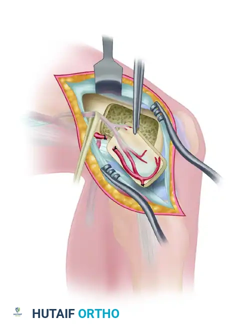 الدليل الشامل لعمليات الترقيع العظمي الدموي لعلاج الكسور المعقدة
