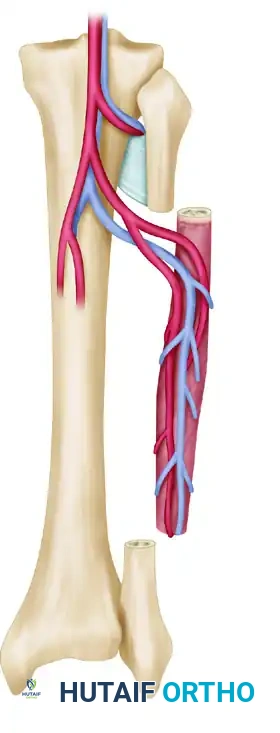 Free Vascularized Bone Transplant: Principles and Surgical Techniques