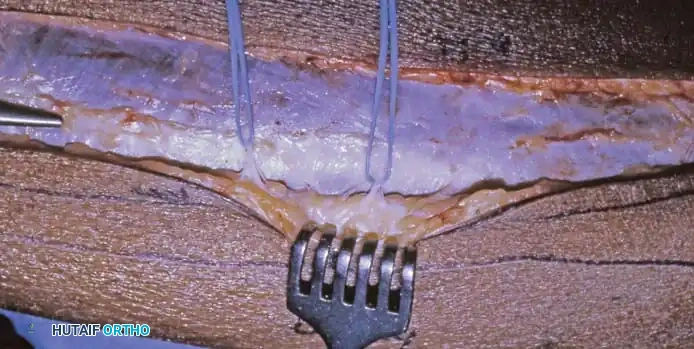 Preoperative Planning and Angiography