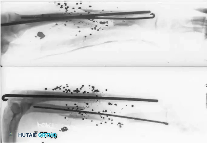 Intraoperative Pedicle Isolation