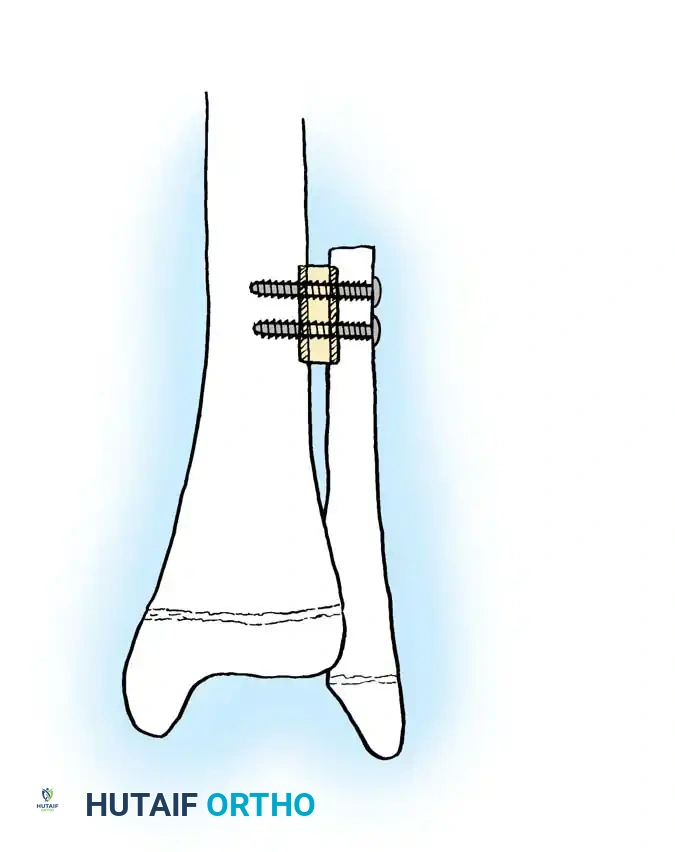 Healed and Hypertrophied Graft