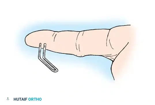 From MacKinnon SF, Dellon AL: Surgery of the peripheral nerve, New York, 1988, Thieme.   Surgical Diagram