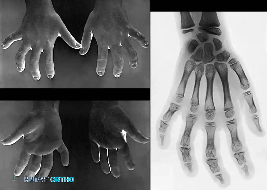 Management of Frostbite and High-Pressure Injection Injuries