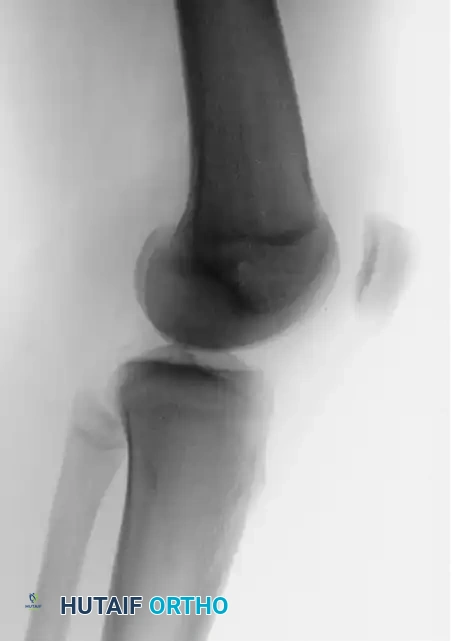 Fulkerson Preoperative Lateral Radiograph