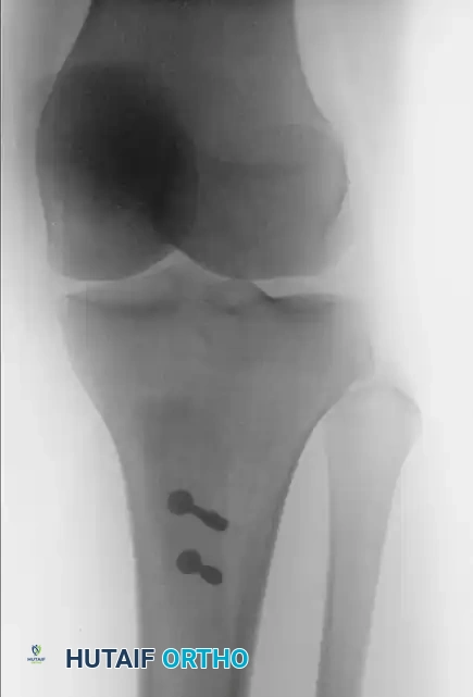 Fulkerson Postoperative AP Radiograph