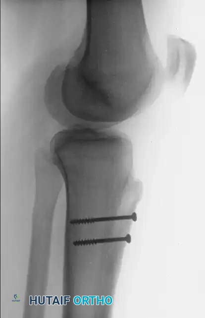 Fulkerson Postoperative Lateral Radiograph