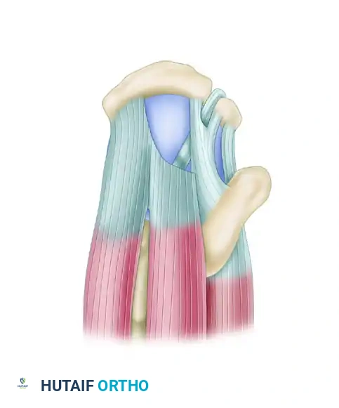 FULL-THICKNESS ROTATOR CUFF TEARS Surgical Diagram