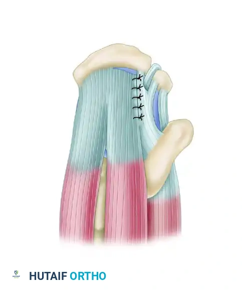 FULL-THICKNESS ROTATOR CUFF TEARS Surgical Diagram