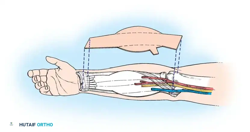Masterclass in Functioning Neuromuscular Transfers and Vascularized Bone Grafts