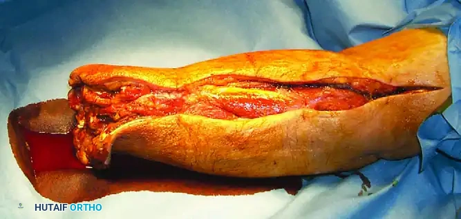 Gas Gangrene and Soft Tissue Complications in Orthopaedic Trauma