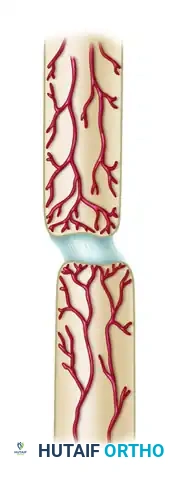 GENERAL TREATMENT OF NONUNIONS Surgical Diagram