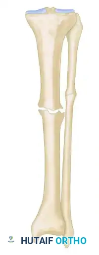 GENERAL TREATMENT OF NONUNIONS Surgical Diagram