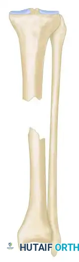 GENERAL TREATMENT OF NONUNIONS Surgical Diagram